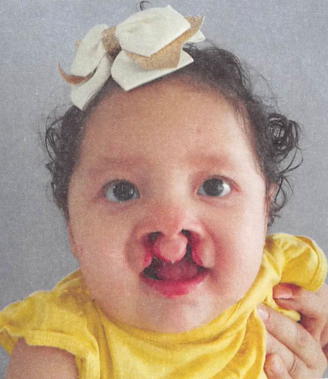 Aitana is just 5 months old and lives in Nicaragua. Thanks to the support of those who donate Smile Train was able to provide her with her brand-new smile.